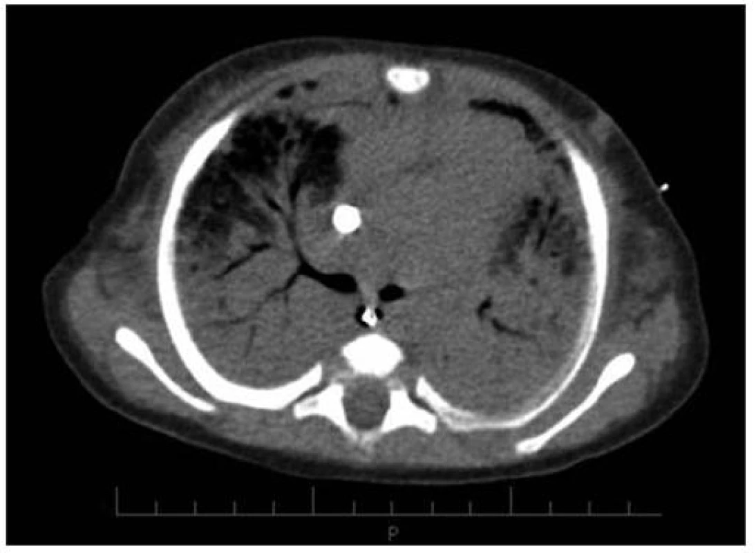 CT vyšetření 16.den (před konverzí V-V na V-A ECMO) u pacientky č. 3.
Fig. 3. CT imaging on day 16 (before V-V conversion to V-A ECMO) in female patient No. 3.