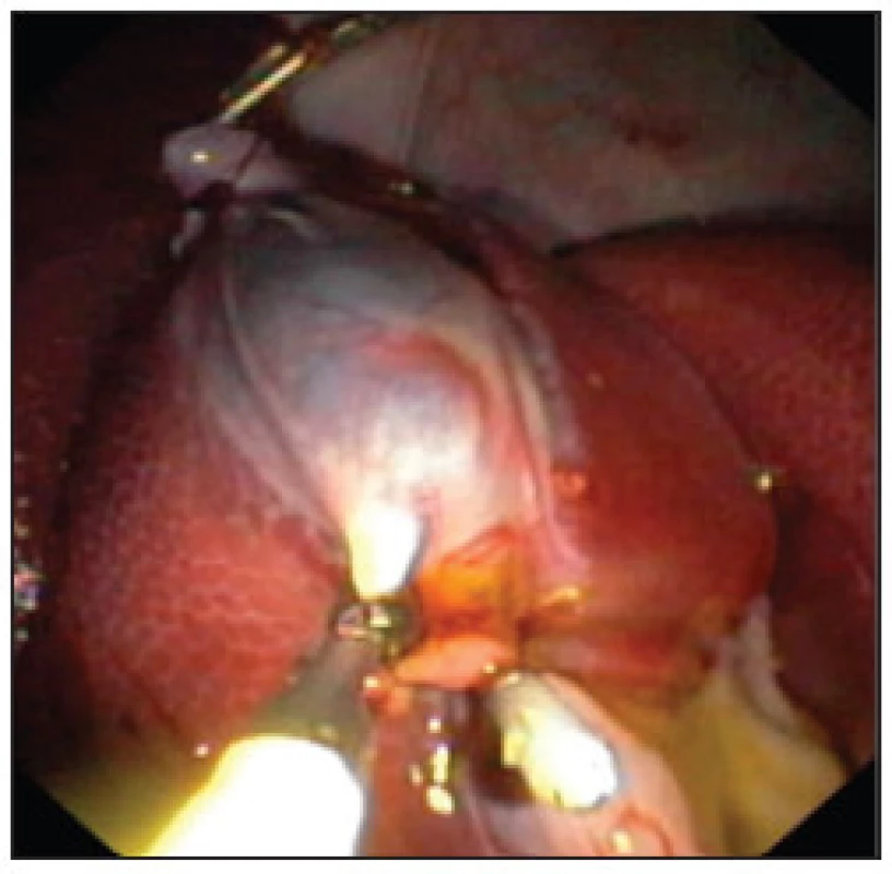 Zaklipování a. a d. cysticus pomocí běžných endoklipů
Fig. 2. Clipping of cystic duct and artery using common endoclips