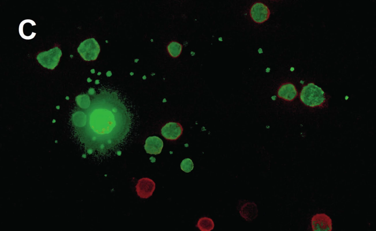 Detekce a kultivace cirkulujících nádorových buněk (16) 
A – imuno-magnetická separace (AdnaTest Prostate Cancer Select), B – kvantifikace exprese tumor-asociovaných genů PSA, PSMA a EGFR kapilární elektroforézou (Adnatest Prostate Cancer Detect), C – imunofluorescenční barvení pancytokeratinem (zeleně) a anti-CD45 (červeně) PSA – prostatický specifický antigen, PSMA – prostatický specifický membránový antigen, EGFR – epidermal growth factor receptor