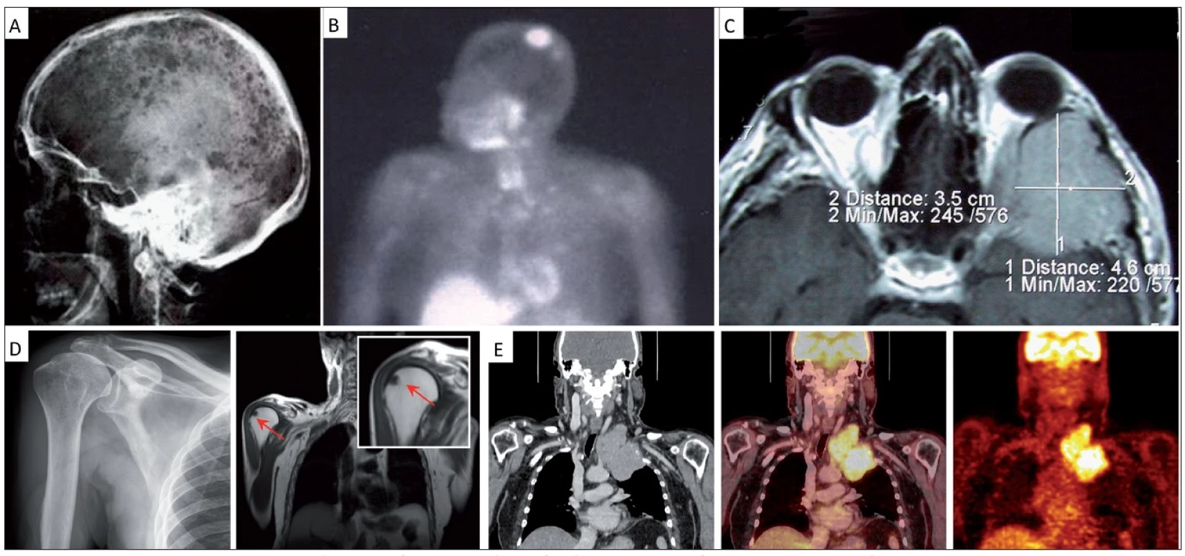 Demonstrace přínosu radiografických a radionuklidových technik v rozpoznání jednotlivých forem myelomové kostní nemoci [14,19].