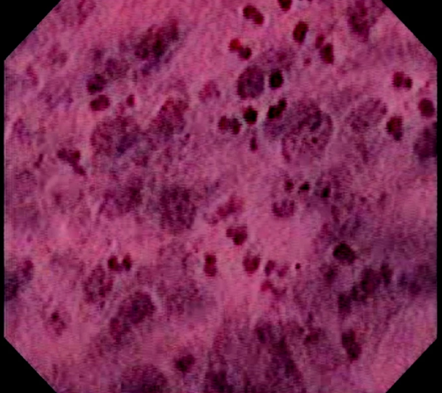 Endocytoskopický obraz karcinomu jícnu