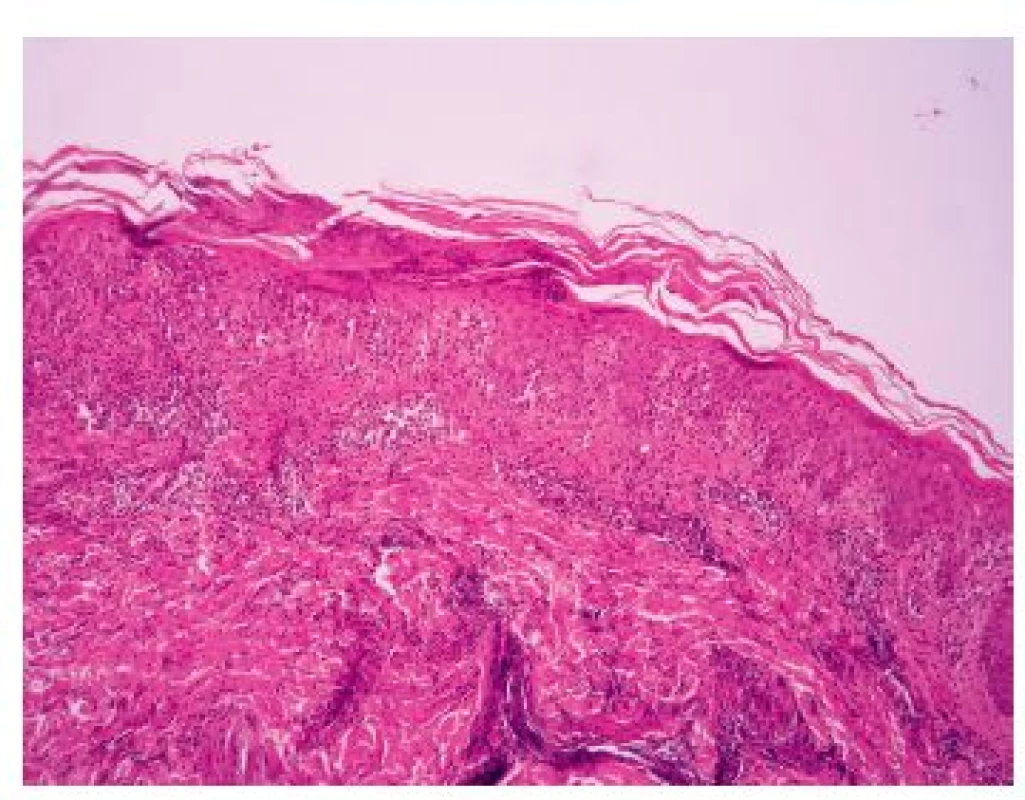 Hyperkeratóza s parakeratózou a fragmenty jader lymfocytů, akantóza, infiltrát lymfocytů s exocytózou do akantotické epidermis