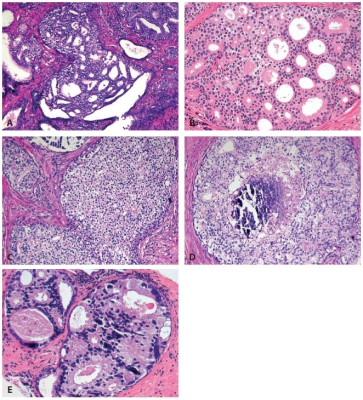 Histological features of intraductal carcinoma of the prostate (IDC-P) include loose cribriform (A), dense cribriform (B), solid growth (C) patterns. Comedonecrosis (D) and marked nuclear pleomorphism with nuclear size >6× of the adjacent non-neoplastic cells (E) are present in some, but not all, the cases. Of these morphological features, dense cribriform and solid patterns, non-focal comedonecrosis, and marked pleomorphic nuclei are diagnostic of IDC-P.