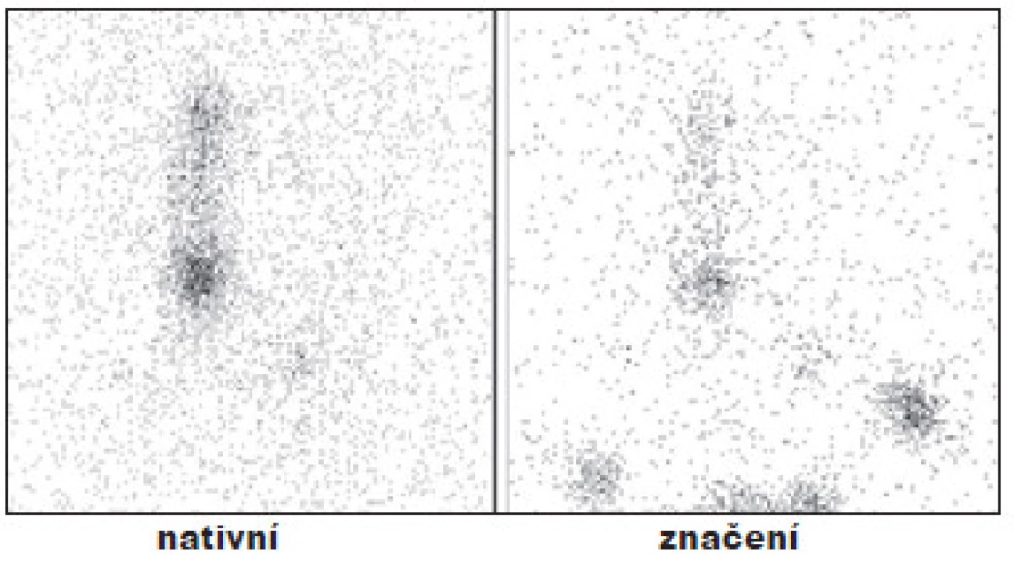 Příklad neúspěšné TERJ.
Vysvětlivky: nativní - stav po nTTE, protáhlý okrsek depozice radiojódu v oblasti lobus pyramidalis; značení - scintigram stejné oblasti se značkou v místě jugula a se značením jizvy po nTTE, hladina Tg 6,6 μg/l, (za 6 měsíců celotělová scintigrafie - perzistující rezidua).