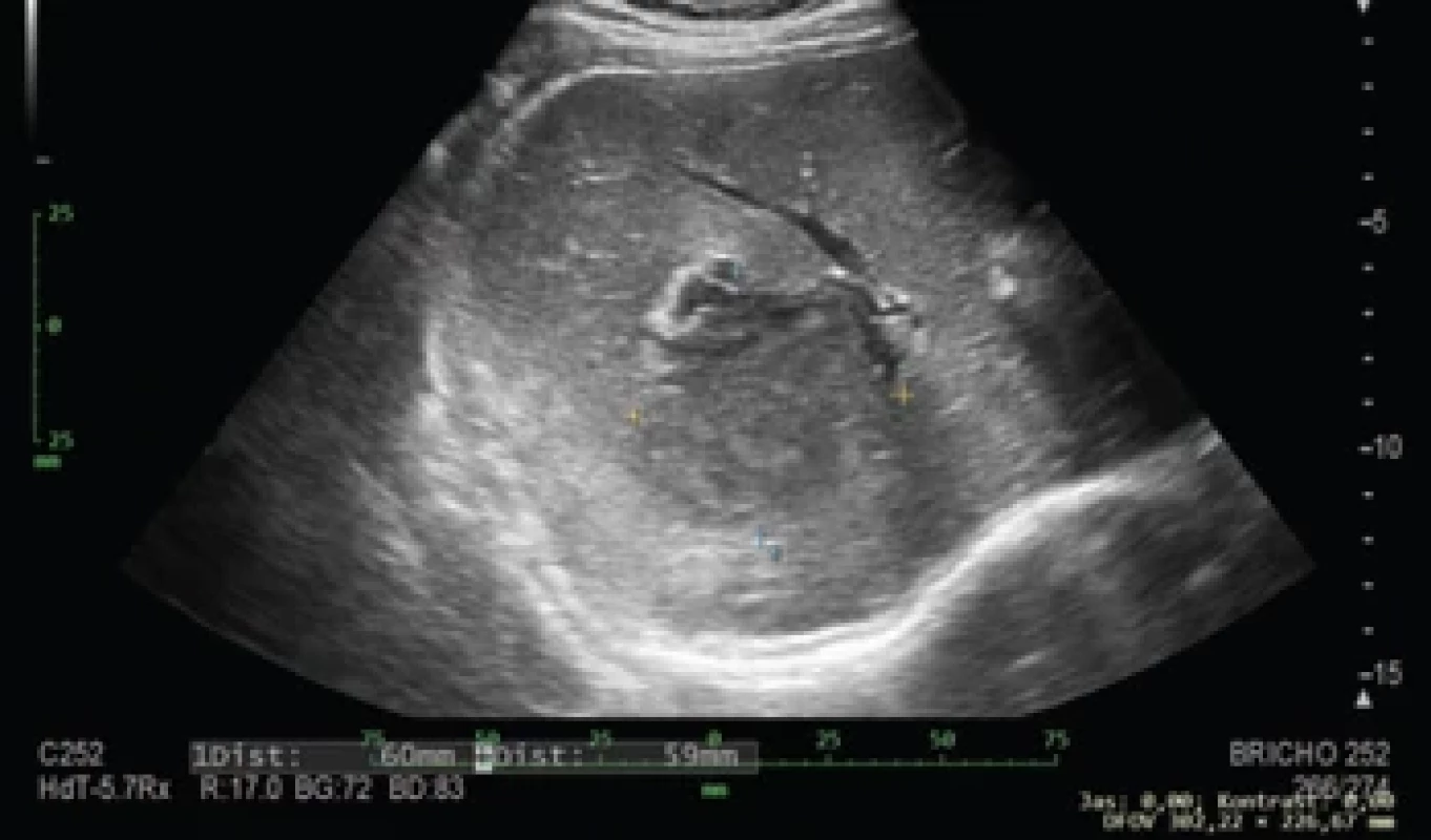 UZ břicha s nálezem abscesového ložiska. (Zdroj: Gastroenterologické oddělení Nemocnice České Budějovice, a.s.)