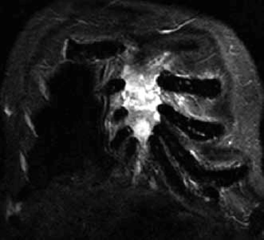 Infiltration of the sternum with myeloma in MR image.