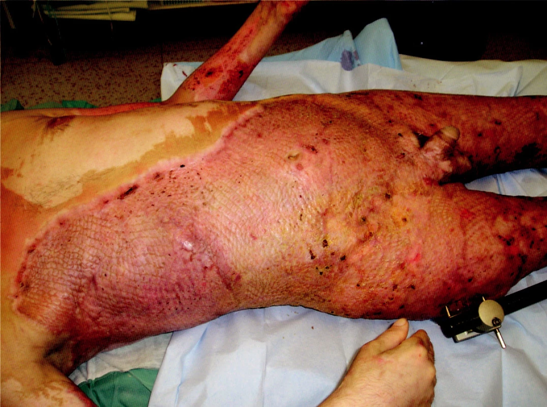 Healed transplanted areas on trunk and right lower extremity, transplanted and harvest areas on the right upper extremity