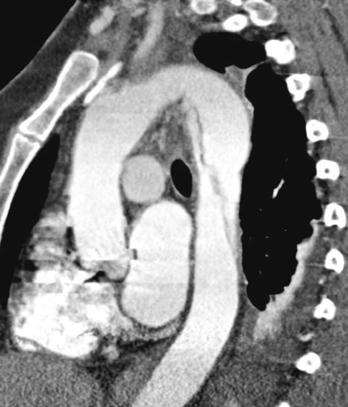 CTA obraz disekce typu B bez komplikací
Pic. 5. A CTA view of the type B dissection with no complications