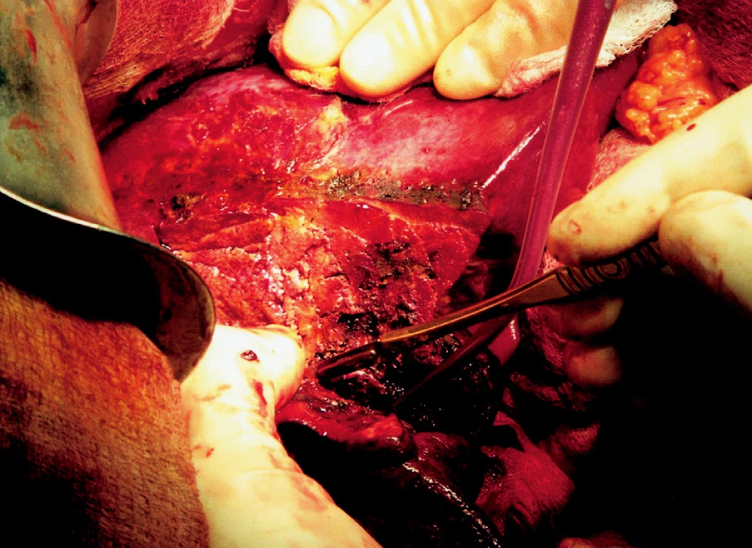 Ostrá transekce jater v místě zkoagulované resekční linie
Fig. 5. Sharp liver transsection at the coagulated resection line site