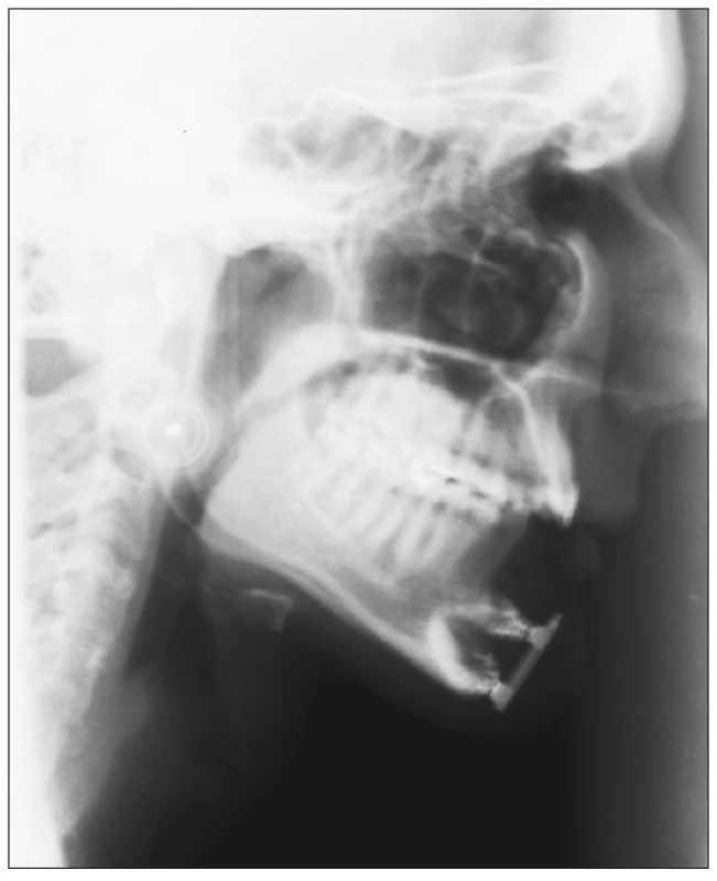 Two-month bone rebuilding – 10 mm new bone increase
