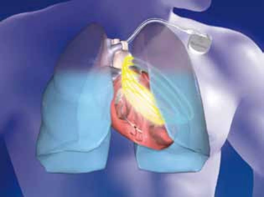 Schéma měření impedance plicní tkáně funkcí Optivol firmy Medtronic mezi vinutím defibrilační elektrody a pouzdrem ICD přístroje.