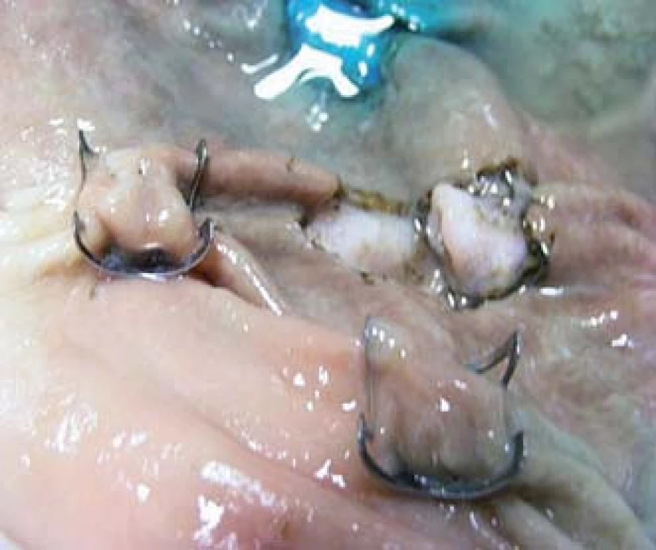 Trénink uzávěru perforací OVESCO klipem na Erlangenském modelu.
Fig. 15. Training of perforations closure with OVESCO clip on an Erlangen model.