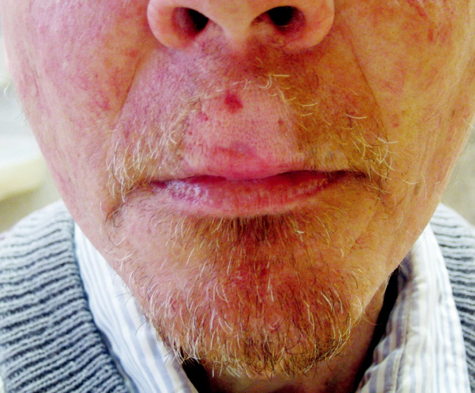 Efekt léčby po 5 měsících sledování
Fig. 4. Treatment outcomes after a 5-month follow up period