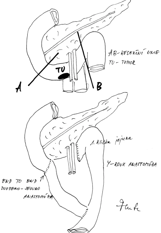 Resekce III. a IV. části dvanáctníku provedena retromezentericky a Y-Roux spojení mezi druhou částí duodena a kličky ilea
Fig. 6: Retromesenteric resection of duodenal parts III and IV and antecolic Y-Roux anastomosis between the duodenum (part II) and the jejunum