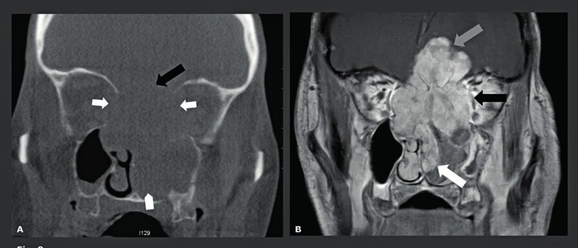 Neschopnost CBCT vizualizovat léze měkkých tkání – spinocelulární karcinom etmoidální dutiny napadající čelní laloky.