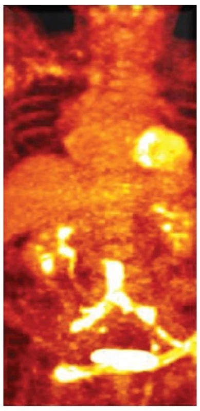 FDG PET CT infekce aortobifemorální rekonstrukce
Fig. 2: FDG PET CT of aortobifemoral graft infection