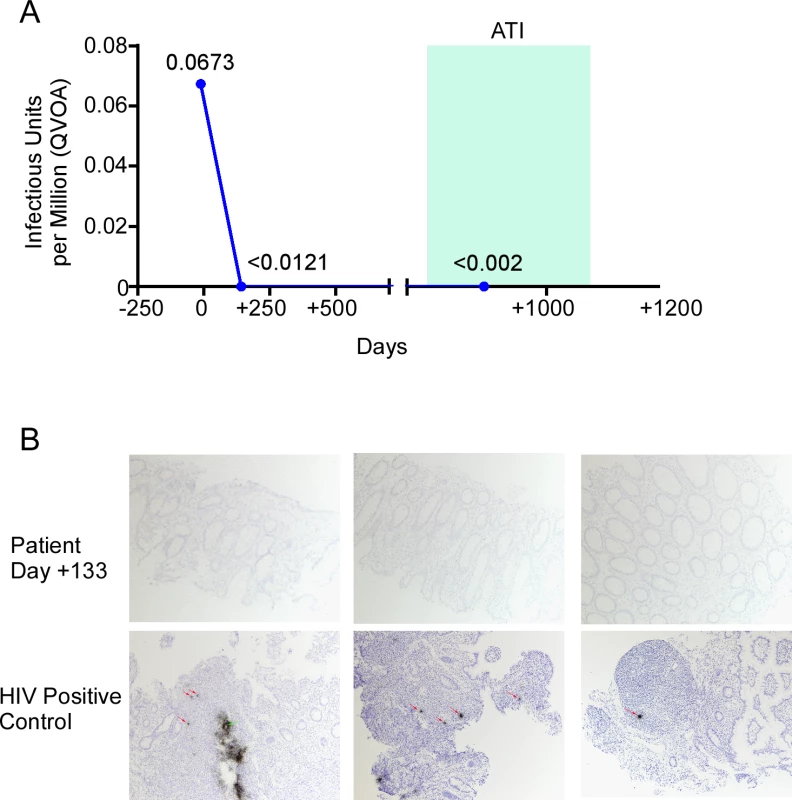 HIV-1 reservoir measurement in the peri-transplant period.