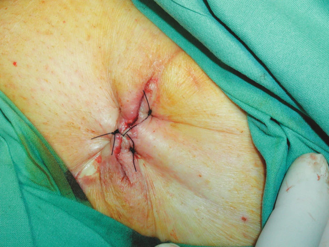 Sutura rány po odstranění V.A.C.
Fig. 9. A wound suture after the V.A.C. system removal