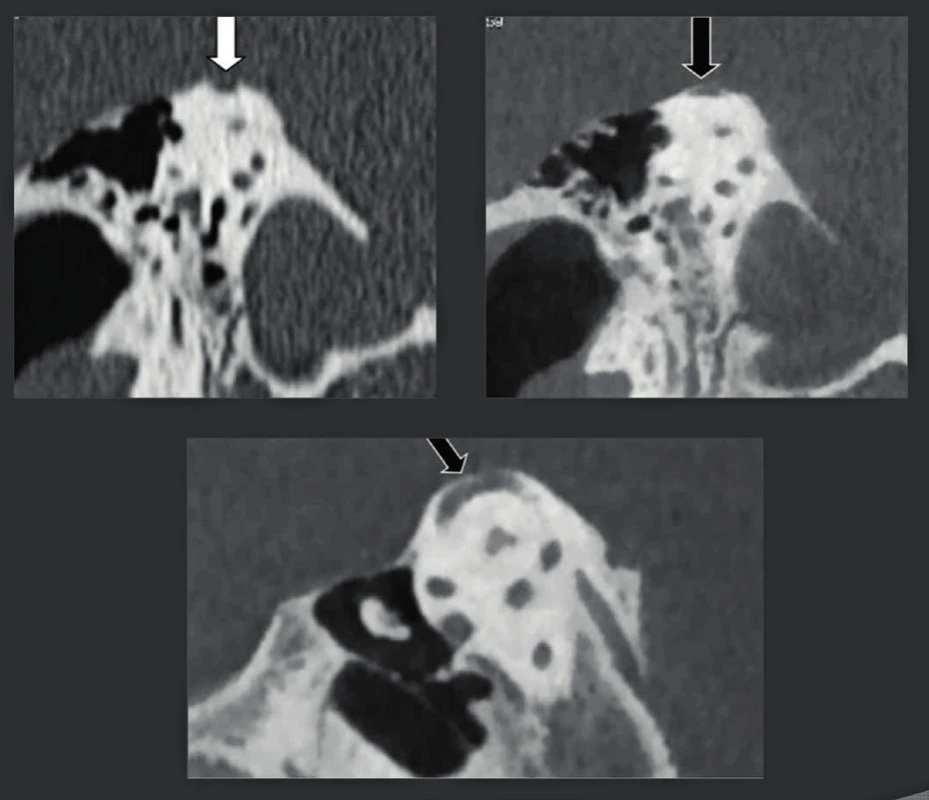 Snímkování dehiscentního horního polokruhového kanálku: pozitivní nález na MDCT, negativní na CBCT.