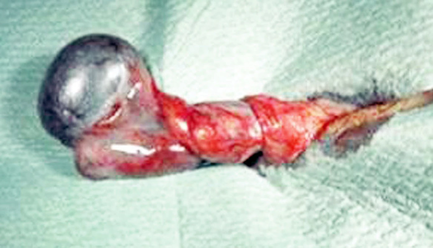 Torzia testis
Fig. 1. Testicular torsion