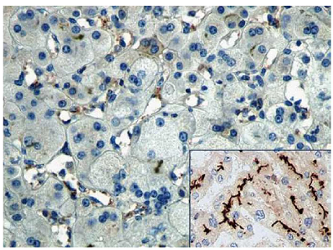 Imunohistochemické barvení na přítomnost proteinu BSEP demonstrující jeho absenci v explantátu jater (zvětšeno 200×). Inset – kanalikulární exprese proteinu ve zdravých játrech (zvětšeno 100x).
Fig. 1. Immunohistochemical staining for the presence of BSEP protein demonstrating its absence in the liver explant (magnification 200×). Inset – canalicular
expression of the protein in normal liver (magnification 100x).