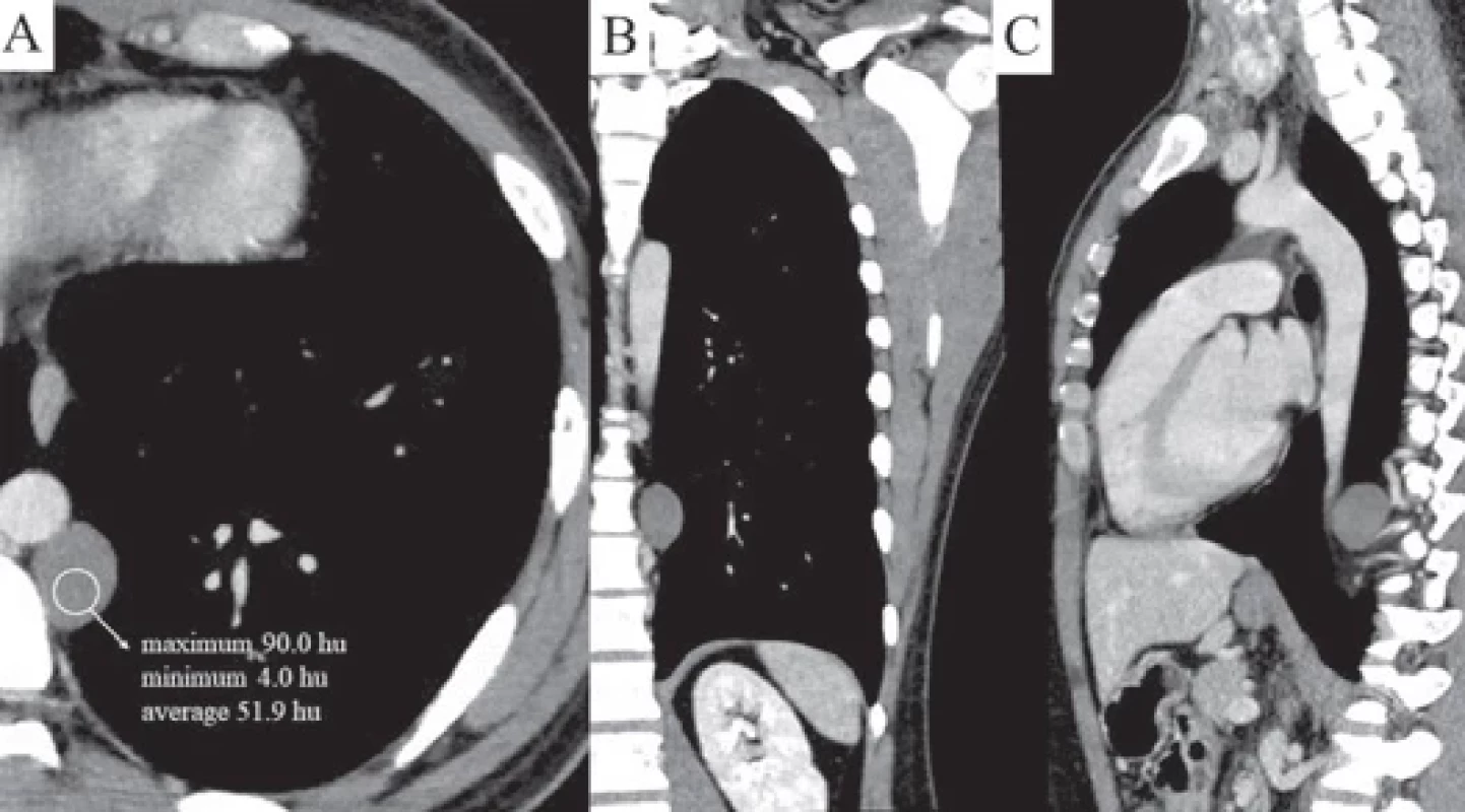 Chest CT scan shows a smooth margin heterogenous nodule with 3 cm in diameter in the posterior mediastinum: transverse view (A), coronal view (B), sagittal view (C).