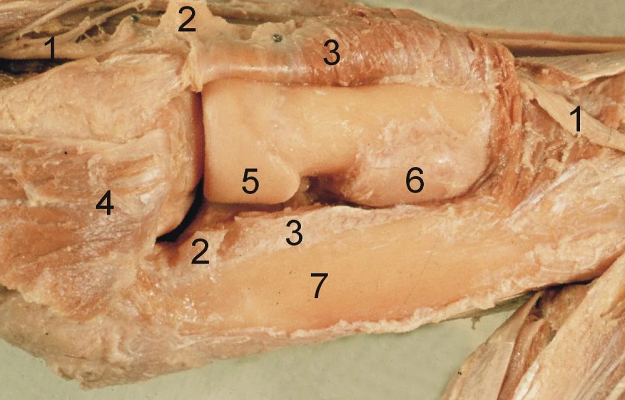 Obr. 23: Boydův přístup na anatomickém preparátu. Je dobře patrné, jak omezená je revize kloubní dutiny při zachování lig. collaterale lat. (srovnej s Obr. 11): 1 – r. profundus n. radialis, 
2 – protnuté lig. anulare radii, 3 – m. supinator, 4 – pro lepší přehled proximálně odklopený m. anconeus (tento krok není součástí Boydova přístupu), 5 – hlavice radia s circumferentia articularis capitis radii (všimni si různé šířky této kloubní plochy), 6 – šlacha m. biceps brachii navinutá na pronovaný radius. <i>(Převzato z Bartoníček J. Operační přístupy u zlomenin hlavičky a diafýzy rádia. Acta Chir Orthop Traumatol Cech 1988;55:497−516.)</i>
Fig. 23: Boyd approach on anatomical specimen. It shows clearly the limited option of revision of the joint cavity due to preservation of lateral collateral ligament (compare with Fig. 11): 1 – deep branch of the radial nerve, 2 – split radial annular ligament, 3 – supinator, 4 – the proximally retracted anconeus allows better visualization (this step is not part of the Boyd approach), 5 – radial head with articular circumference of radial head (note the different width of this articular surface), 6 – biceps brachii tendon rolled around the pronated radius. <i>(Reprinted from Bartoníček J. Operační přístupy u zlomenin hlavičky a diafýzy rádia [Surgical approaches in fractures of the head and shaft of radius]. Acta Chir Orthop Traumatol Cech 1988;55:497−516.)</i>
