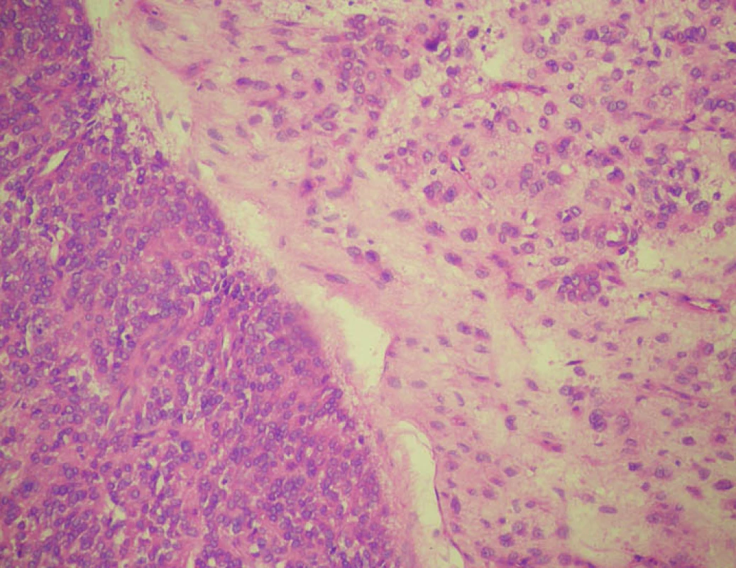 EGIST s oběma populacemi nádorových buněk oddělených poměrně ostrou hranicí. Barvení hematoxylin-eozin
Fig. 3: EGIST with both tumour cell populations separated by a relatively sharp border. Hematoxylin-eosin stain