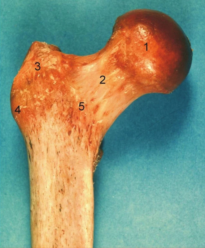 Proximální femur, pravá strana, pohled zpředu: 1 – caput femoris, 2 – collum femoris, 3 – trochanter major, 4 – tuberculum vastoabductorium, 5 – linea intertrochanterica.
Fig. 1: Proximal femur, right side, anterior aspect: 1 – caput femoris, 2 – collum femoris, 3 – trochanter major, 4 – tuberculum vastoabductorium, 5 – linea intertrochanterica.