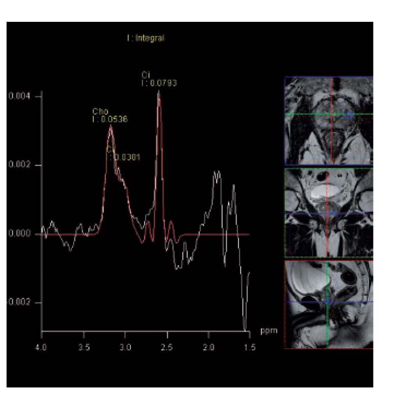 MR spektroskopie – elevace hladiny cholinu s poklesem hladiny citrátu jako známka podezření na karcinom prostaty v periferní zóně vlevo 
Fig. 4. MR spectroscopy – elevation of choline level with a decrease in citrate level is the spectral signature of suspection of prostate cancer in the left peripheral zone of the prostate