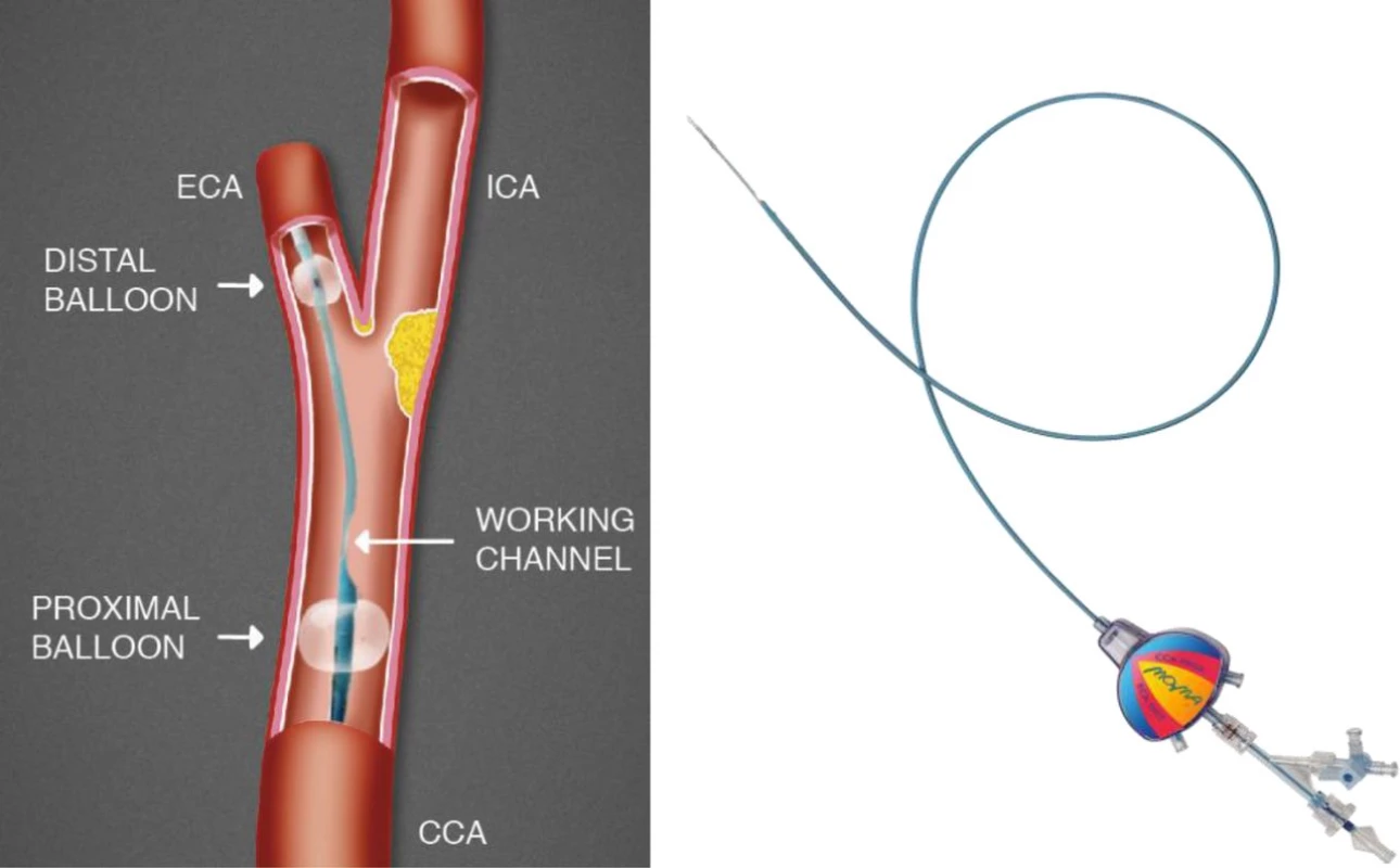 Proximální protekce (Mo.Ma Device, Medtronic)