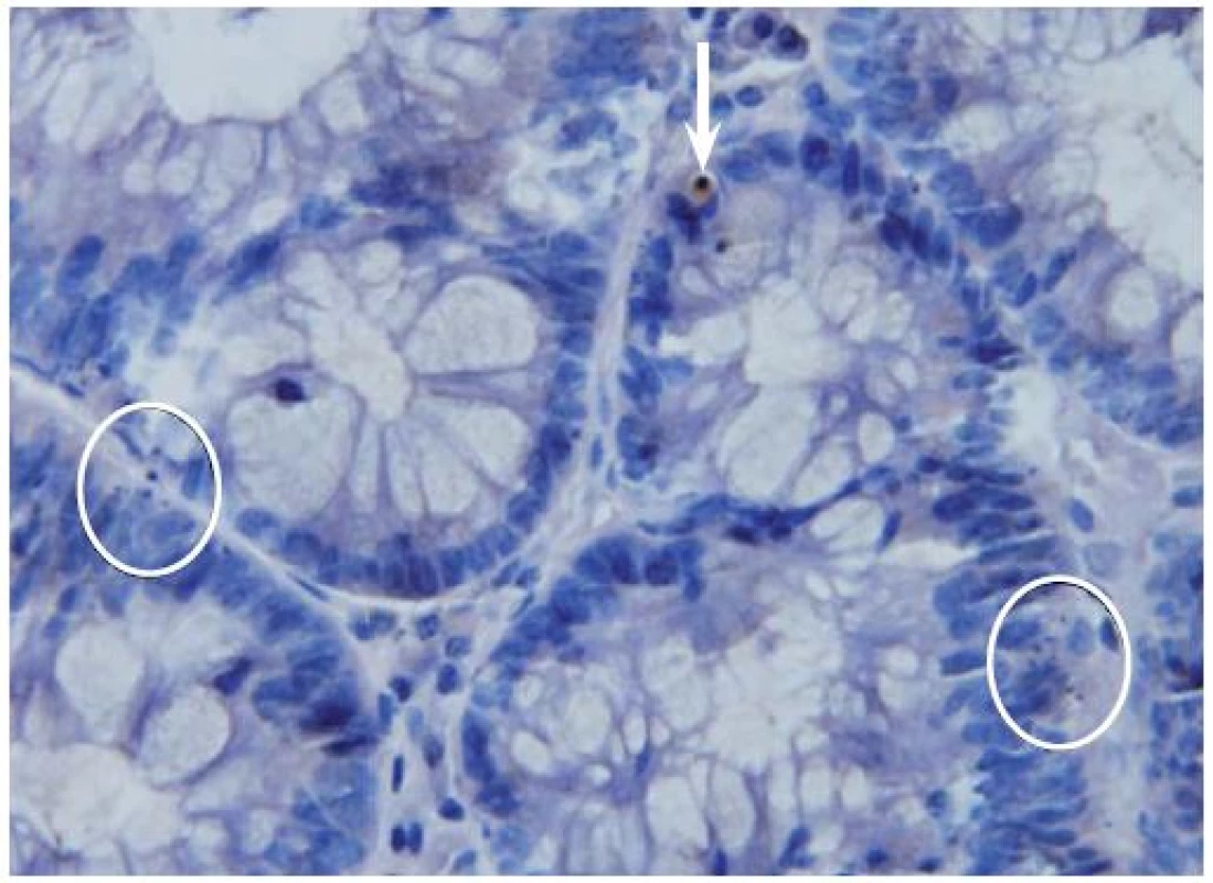 Imunohistochemická detekce aktivované kaspázy-3 ve vzorcích dobarvených hematoxylinem. Zvětšeno 500×. Na obrázku jsou znázorněny aktivovaná kaspáza-3 pozitivní buňky (šipka). Rovněž jsou zde patrny dva shluky  ≥ 3 apoptotických tělísek (v kroužku), jež by při hodnocení ve vzorcích barvených hematoxylin-eozinem byly považovány za pozitivní, avšak pozitivitu aktivované kaspázy-3 nevykazovaly. Apoptotická tělíska vykazovala pozitivitu jen tehdy, pokud v nich byla zachována cytoplazmatická hmota. Jestliže tělísko obsahovalo pouze jaderný materiál, pozitivita nebyla zachycena.
Fig. 1. Immunohistochemical detection of activated caspase-3 with subsequent haematoxylin staining. Original magnification ×500. Activated-caspase-3 positive cells are shown in the picture (arrow). Two clusters ≥ 3 of apoptotic bodies (in circle) are also present; these would be positive for haematoxylin-eosin stain­ing, but have not shown positivity of activated-caspase-3. Apoptotic bodies were only seen if the cytoplasmatic tissue was maintained. If the apoptotic body only contained nuclear ma-terial, positivity was not observed.