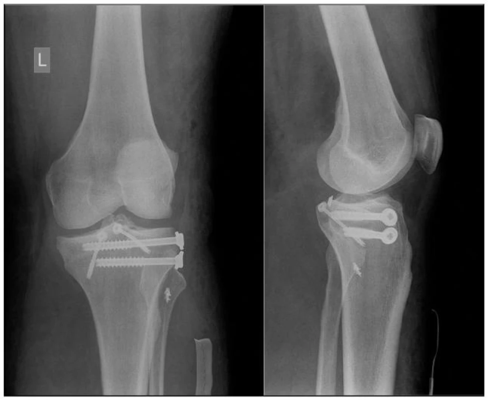 Stav po provedení osteosyntézy pro přítomnost avulzního vytržení tibiálního úponu ZZV, Segondovu zlomeninu a abrupci apexu fibuly