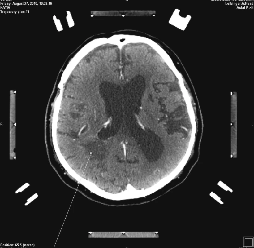 Plánování stereotaktické biopsie
Fig. 2. Planned stereotactic biopsy