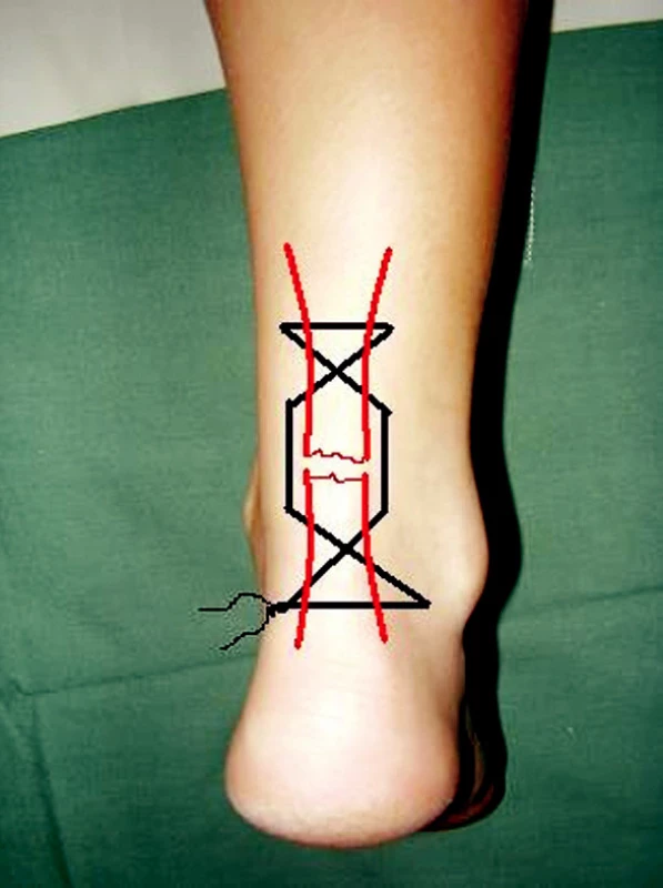 Perkutánní sutura – dokončení
Pic. 5. Percutaneous repair – accomplishment