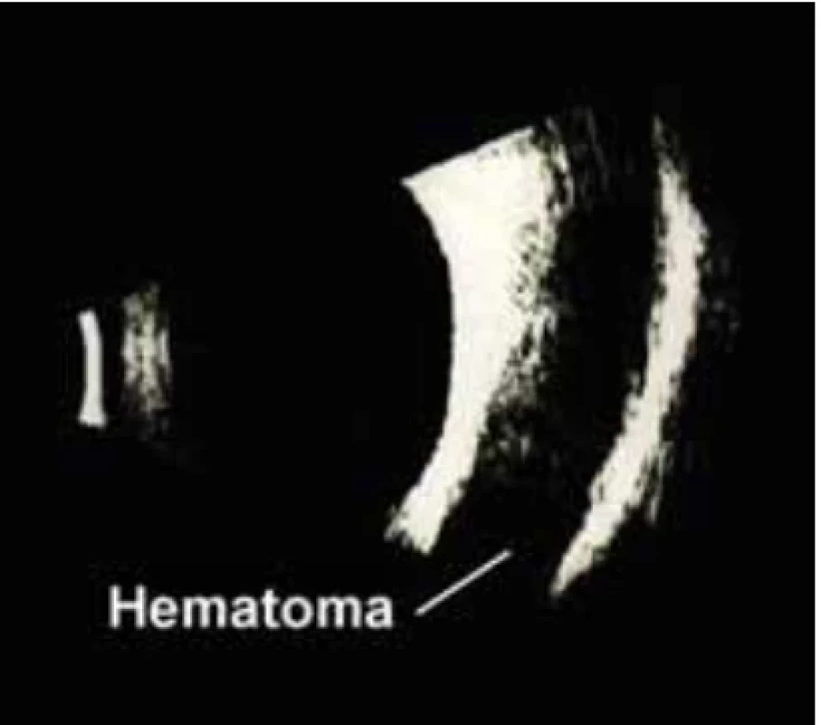Retrobulbar subperiosteal hematoma. // Retrobulbární subperiostální krvácení.