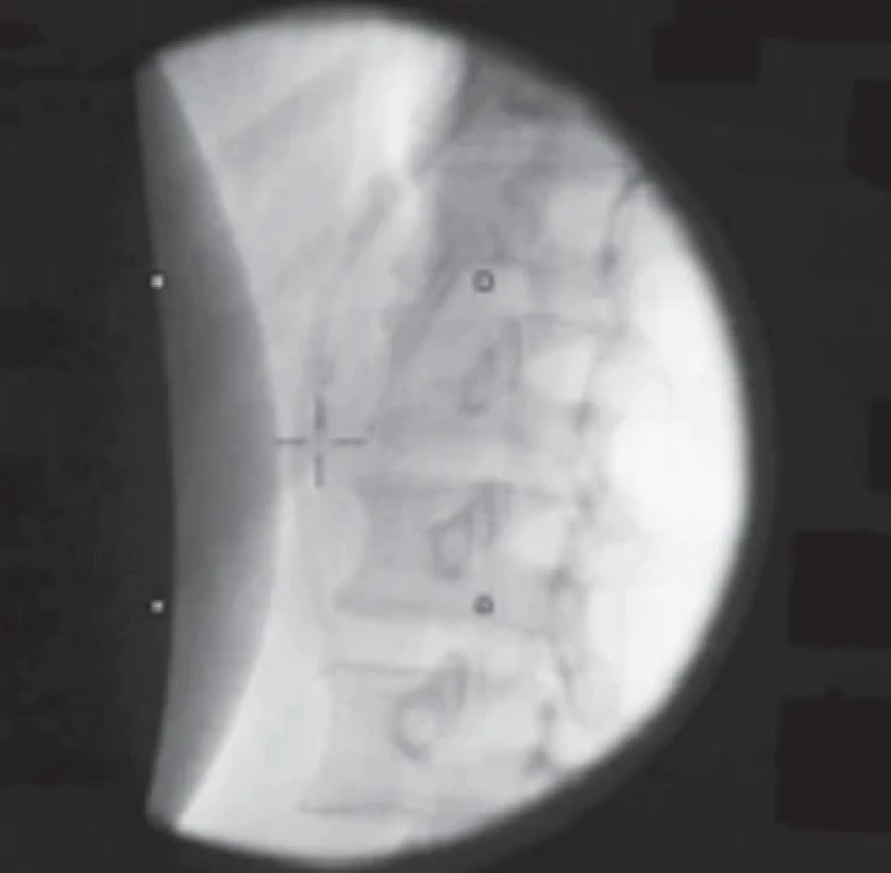 Skiaskopické zobrazení pankreatikolitiázy po ESWL. Fig. 3. Fluoroscopic image of pancreatic lithiasis following ESWL.
