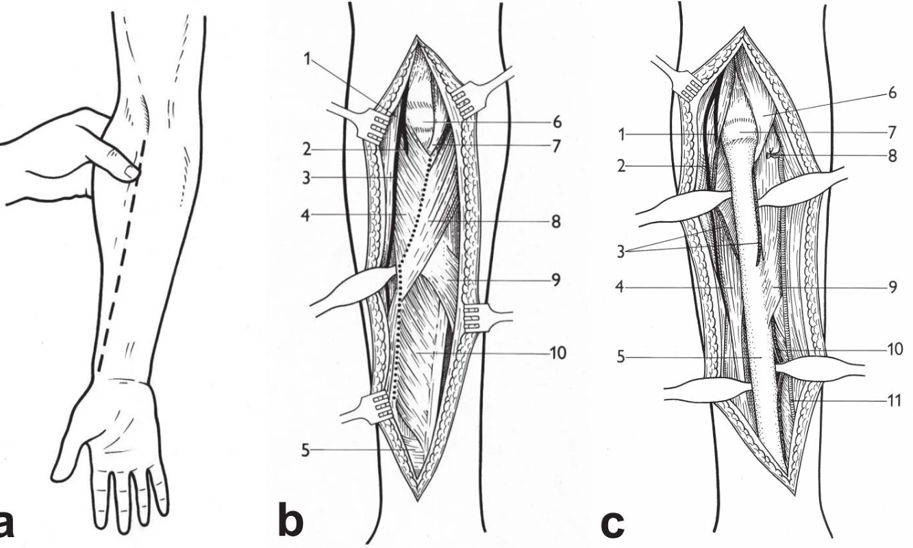 Henryho přístup – schéma: a – identifikace „mobile wad“; b – linie preparace: 1 – m. brachioradialis, 2 – r. profundus n. radialis, 3 – r. superficialis n. radialis, 4 – m. supinator, 5 – m. pronator quadratus, 6 – kloubní pouzdro kryjící hlavici radia, 7 – šlacha m. biceps brachii, 8 – m. pronator teres, 9 – m. flexor digitorum superficialis (caput radiale), 10 – m. flexor pollicis longus; 
c – stav po uvolnění svalů: 1 – r. profundus n. radialis, 2 – r. superficialis n. radialis, 3 – m. supinator, 4 – m. brachioradialis, 5 – diafýza radia, 6 – šlacha m. biceps brachii, 7 – kloubní pouzdro kryjící hlavici radia, 8 – podvázaná a. radialis recurrens, 9 – m. pronator teres, 10 – m. flexor pollicis longus, 11 – a. radialis. <i>(Reprinted from Bartoníček J. Operační přístupy u zlomenin hlavičky a diafýzy rádia [Surgical approaches in fractures of the head and shaft of radius]. Acta Chir. Orthop Traumatol Čech 1988;55:497−516.)</i>
Fig. 8: Henry approach – drawings: a – identification of the mobile wad; b – dissection line:
 1 – brachioradialis, 2 – deep branch of radial nerve, 3 – superficial branch of radial nerve, 
4 – supinator, 5 – pronator quadratus, 6 – joint capsule covering radial head, 7 – biceps brachii tendon, 8 – pronator teres, 9 –flexor digitorum superficialis (radial head), 10 – flexor pollicis longus; c – situation after muscle detachment: 1 – deep branch of radial nerve, 2 – superficial branch of radial nerve, 3 – supinator, 4 – rachioradialis, 5 – radial shaft, 6 – biceps brachii tendon, 7 – joint capsule covering radial head, 8 – ligated radial recurrent artery, 9 – pronator teres, 10 – flexor pollicis longus, 11 – radial artery. <i>(Reprinted from Bartoníček J. [Surgical approaches in fractures of the head and shaft of radius]. Acta Chir Orthop Traumatol Čech 1988;55:497−516.)</i>