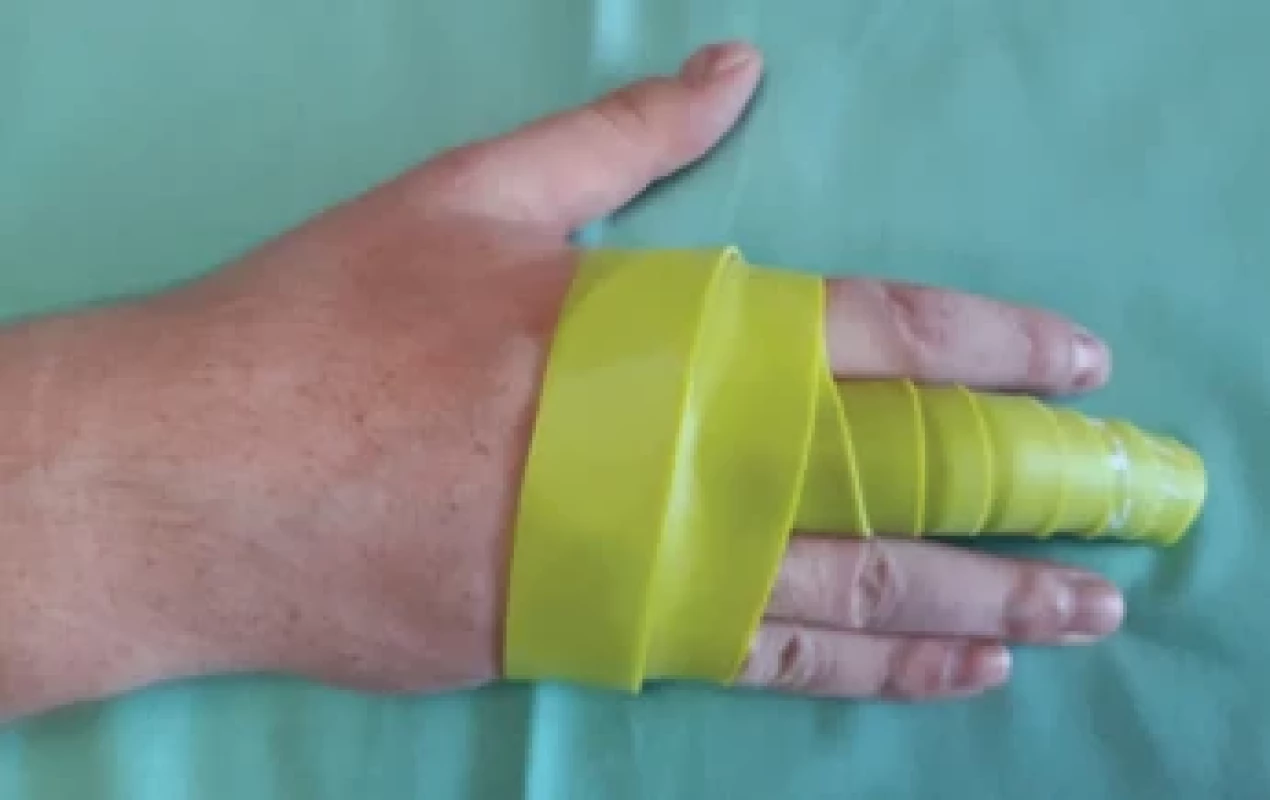 Aplikace fl ossingu na III. prst pravé ruky.</br> Fig. 2. Application of the fl ossband on the third fi nger of the right hand.