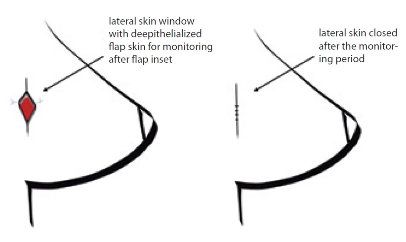 Francis et al. (2022) delayed primary retention suture (DPRS) technique [5].