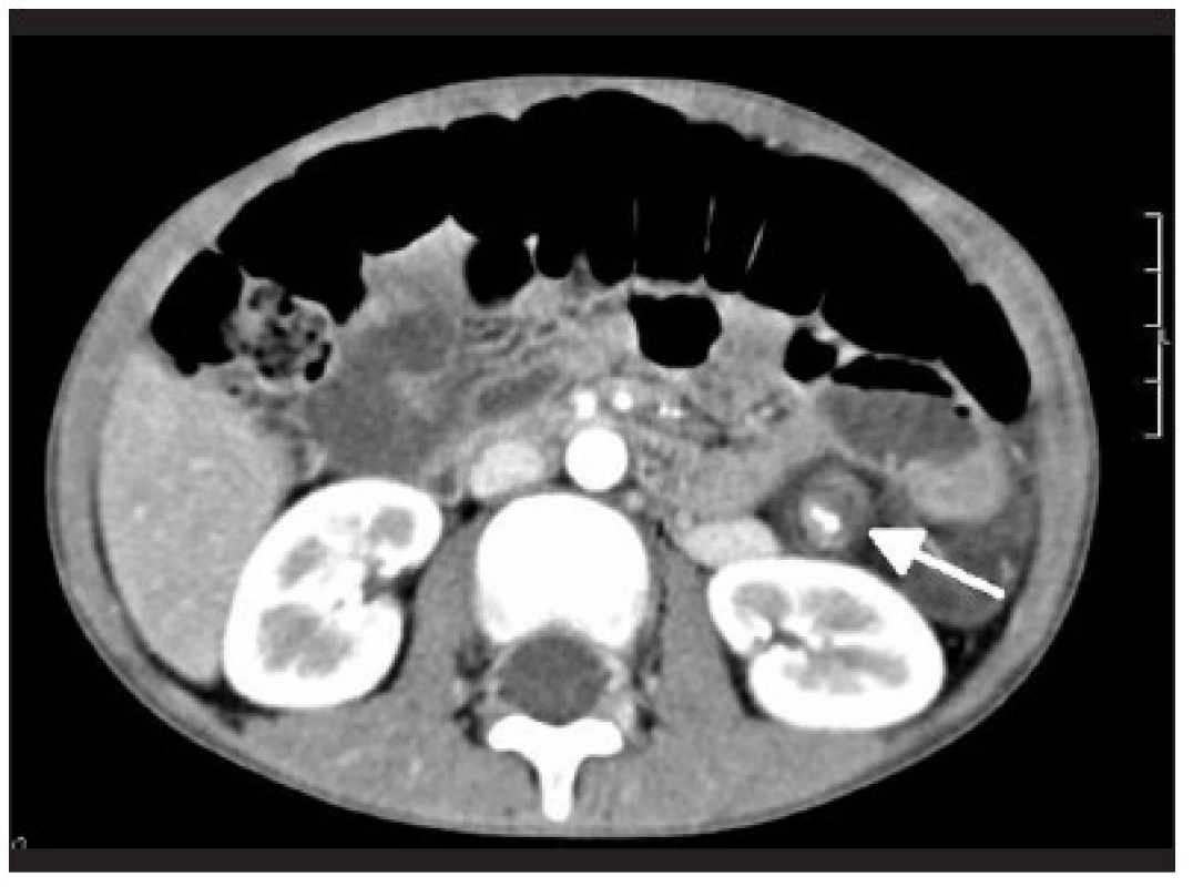 CT angiografia torzie lienálnej artérie
Fig. 4. CT angiography of splenic artery torsion