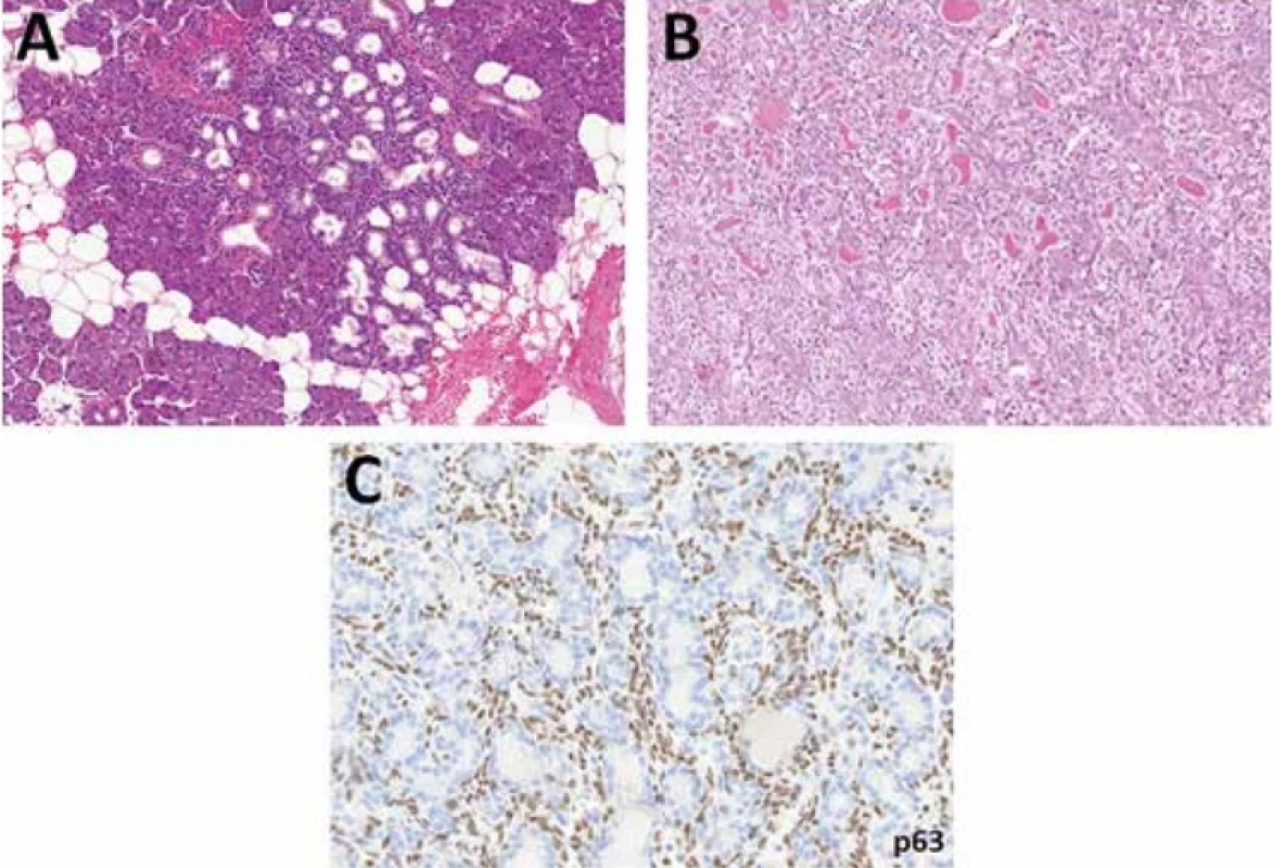 Hyperplázie (A) a adenom z buněk vmezeřených vývodů/intercalated duct adenoma (B) jsou bifázické benigní léze tvořené duktálním luminálním epitelem a abluminální vrstvou myoepiteliálních buněk, zde pozitivních na p63 (C).