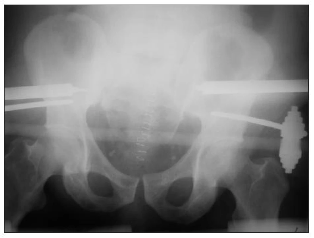 RTG snímek pánve po provedení rerepozice zlomeniny 10. den od přijetí s ponecháním zevní fixace a pánevní svorky
Fig. 2. X-ray picture of pelvis after re-reduction of the fracture 10 days after admission. The fracture remainded stabilised by external fixator and pelvic C-clamp