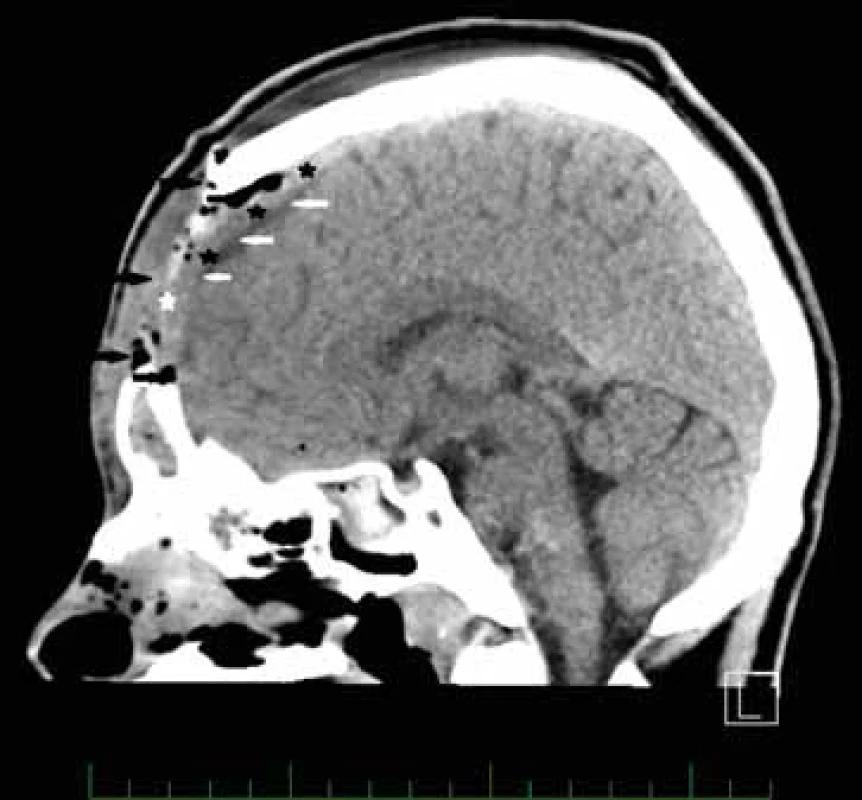 CT hlavy po operaci, parasagitální rovina vlevo, vyšetření po intravenózní aplikaci kontrastní látky. Minimální opacifi kující se reziduum infi ltrace v podkoží s drobnými bublinkami vzduchu frontálně v podkoží a pod kalvou (černé šipky), defekt kosti (bílá hvězdička), malá, neexpandující tekutinová kolekce intrakraniálně. Extraaxiálně (bílé šipky), přetrvává opacifi kace mozkových obalů (černé hvězdičky).
