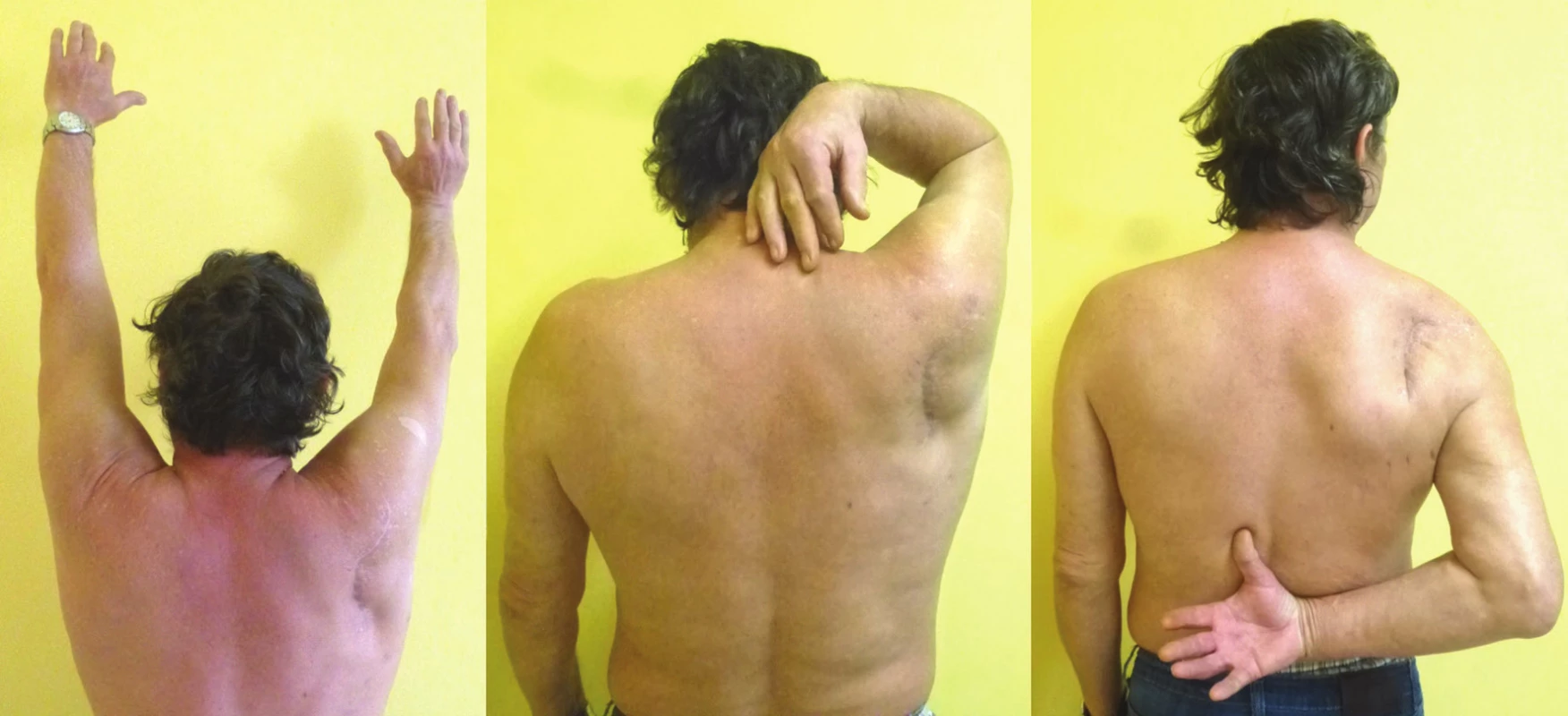 Functional result (Pt 3) in four-part glenoid fossa fracture with separation in the anatomical neck and fracture of the scapular body