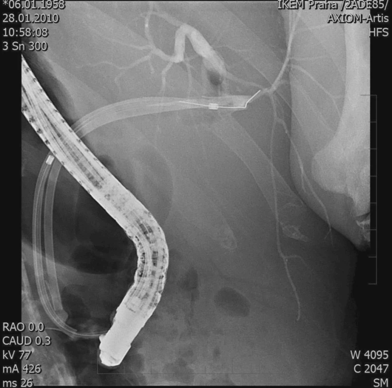 ERCP – stenóza žlučovodu, 3 stenty
Fig. 4. ERCP – biliary duct stenosis, 3 stents