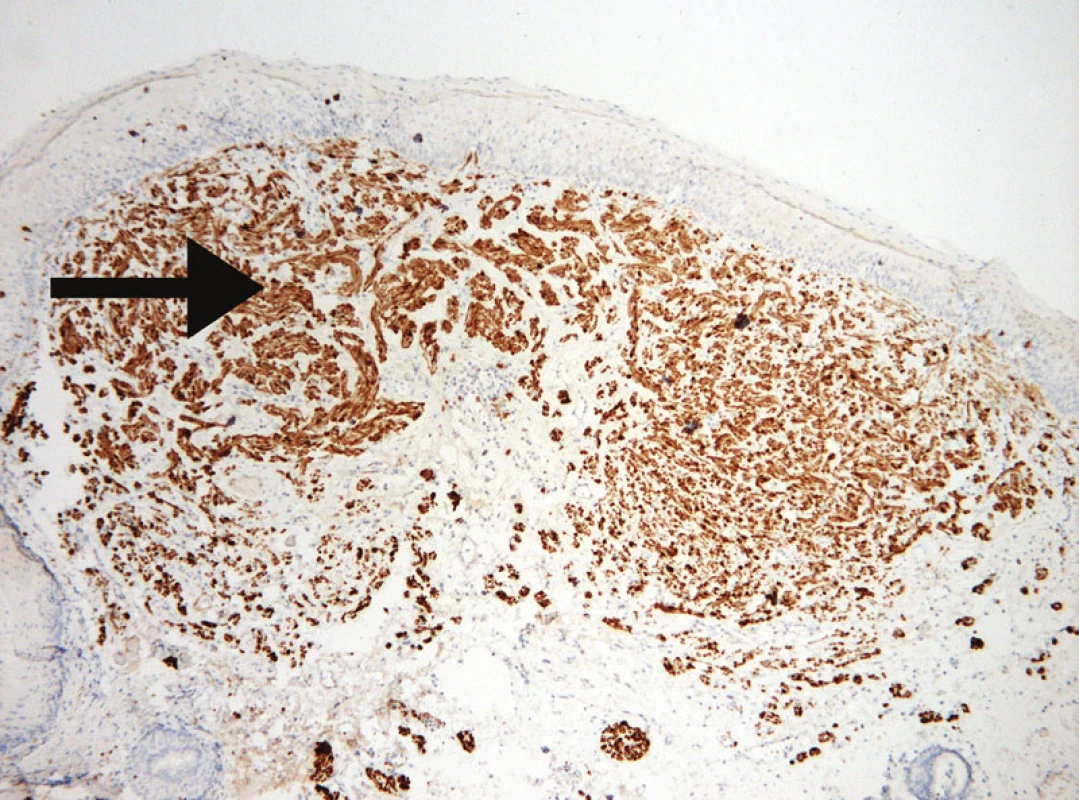 Nádorové buněčné elementy neurofibromu silně pozitivně exprimující S-100 protein (viz černá šipka) (zvětšeno 10krát).