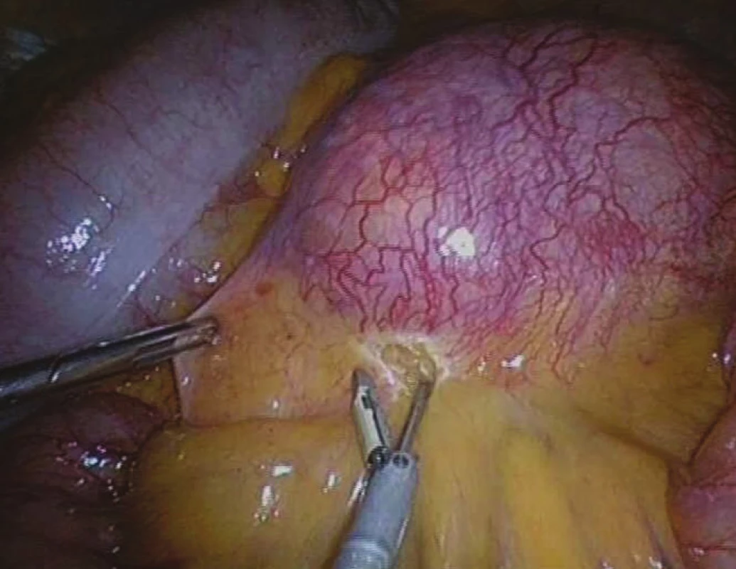 Nádor mezenteria, preparace pomocí nástroje Thunderbeat
Fig. 5: Mesenteric tumour, preparation using Thunderbeat instrument