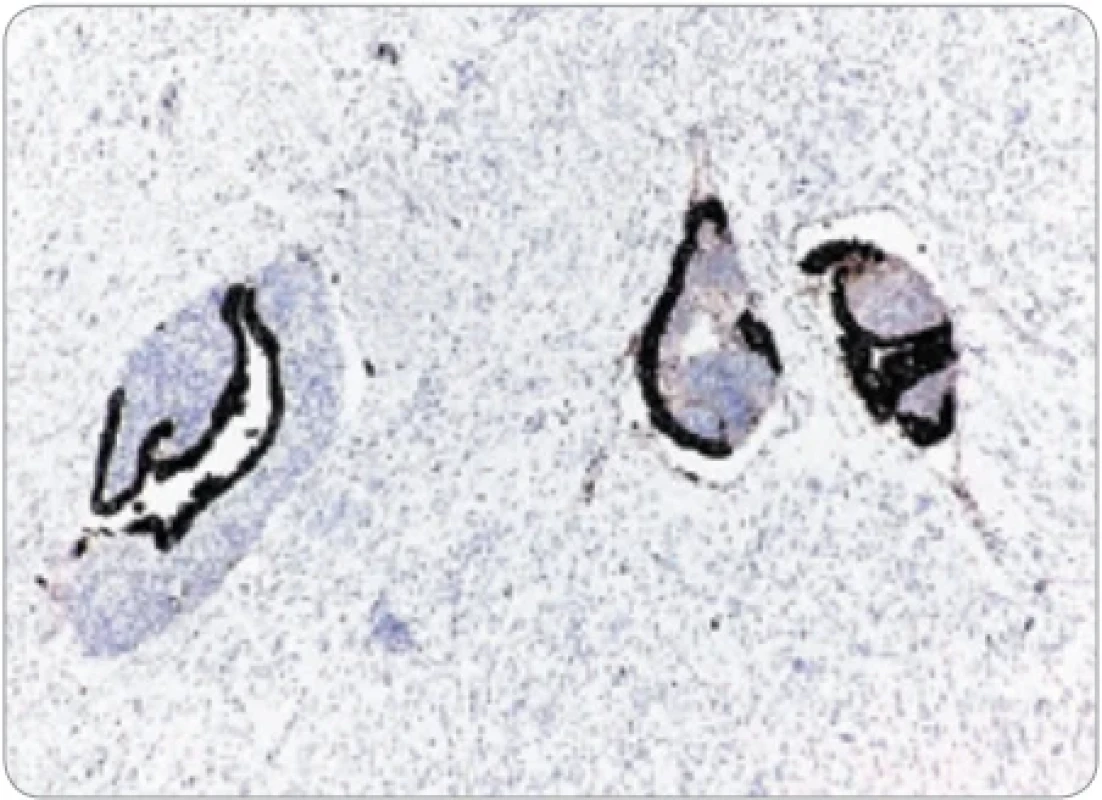  Imunohistochemická pozitivita endometriálneho žľazového epitelu v cievach na CK 7. (Zväčšenie 200×).