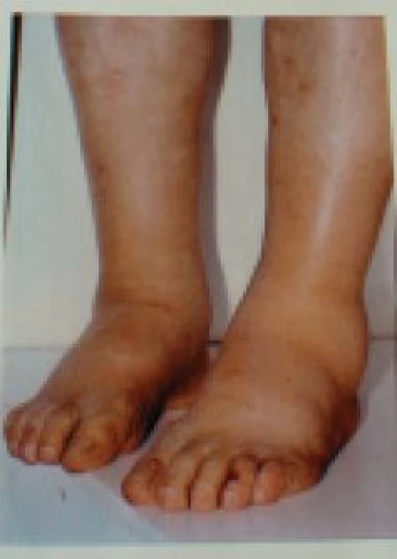 Symetrické otoky DK jsou vždy suspektní z nefrotického syndromu (velká proteinurie, závažná hypoalbuminemie a hypoproteinemie, otoky nohou, sklon k tromboembolizmu).